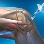 Medical & Injection Therapies (Osteoarthritis & Joint Conditions)