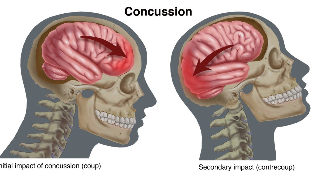 Mild Traumatic Brain Injury Archives - Dr. Joshua ScottDr. Joshua Scott